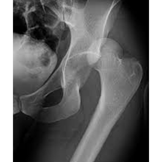 X-ray Left Hip with Thigh LAT